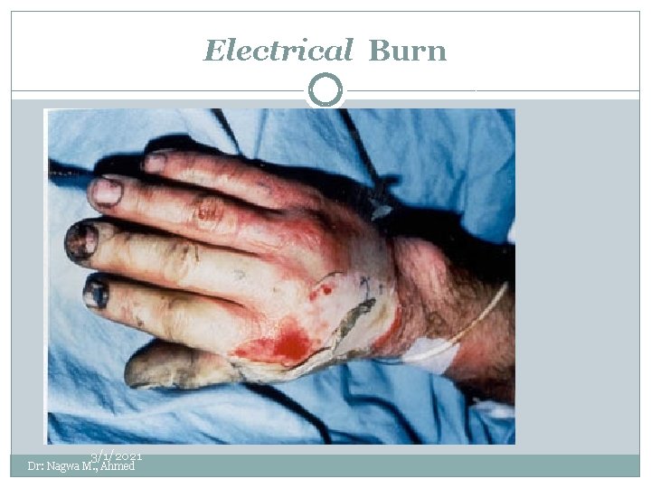 Electrical Burn 3/1/2021 Dr: Nagwa M. , Ahmed 
