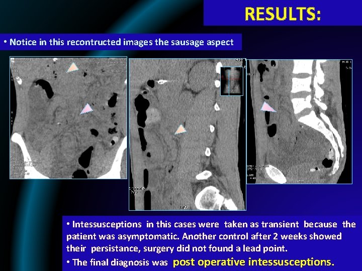 RESULTS: • Notice in this recontructed images the sausage aspect • Intessusceptions in this