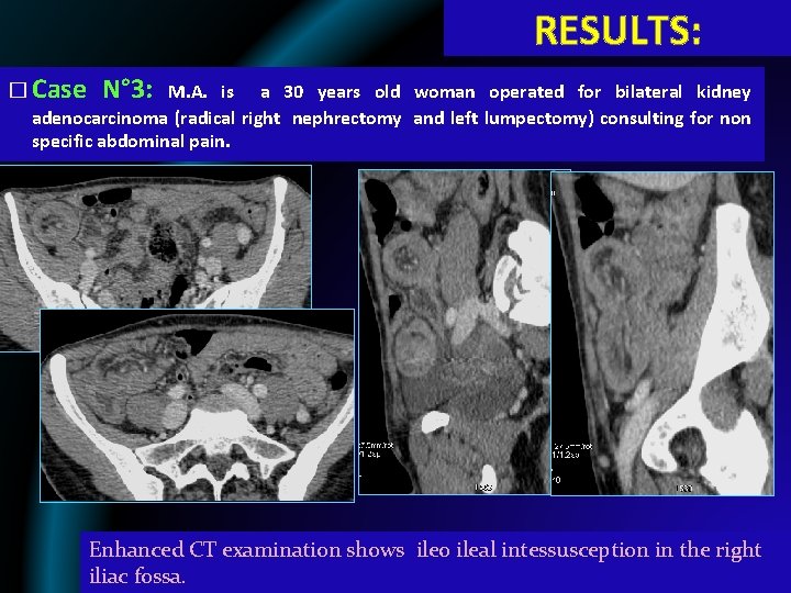 RESULTS: � Case N° 3: M. A. is a 30 years old woman operated