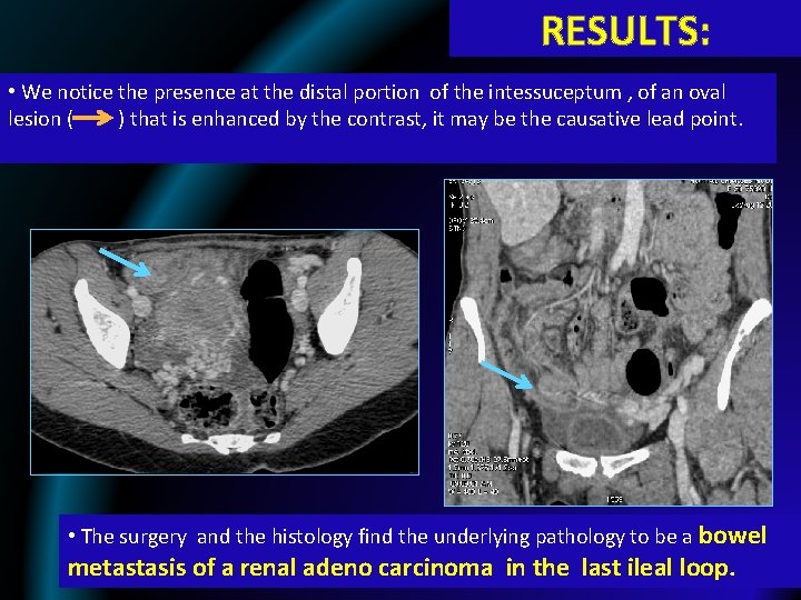 RESULTS: • We notice the presence at the distal portion of the intessuceptum ,