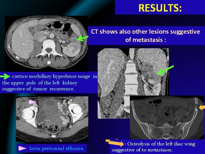 RESULTS: CT shows also other lesions suggestive of metastasis : : cortico medullary hypodense