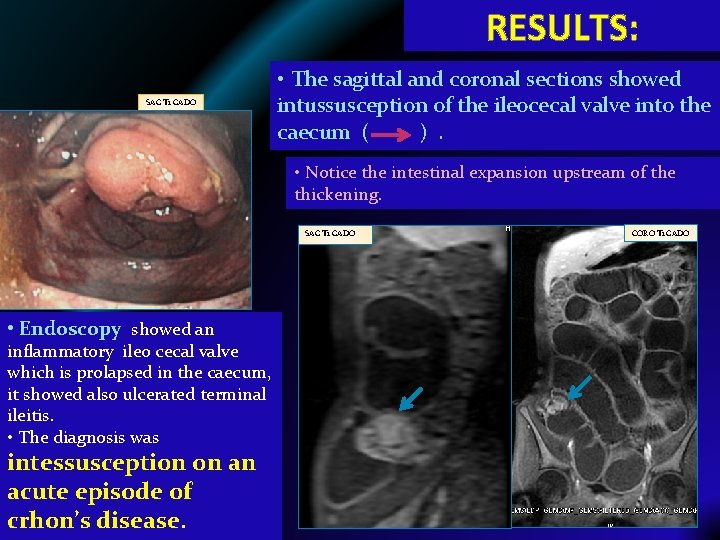 RESULTS: SAG T 1 GADO • The sagittal and coronal sections showed intussusception of