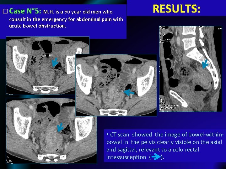 � Case N° 5: M. H. is a 60 year old men who consult