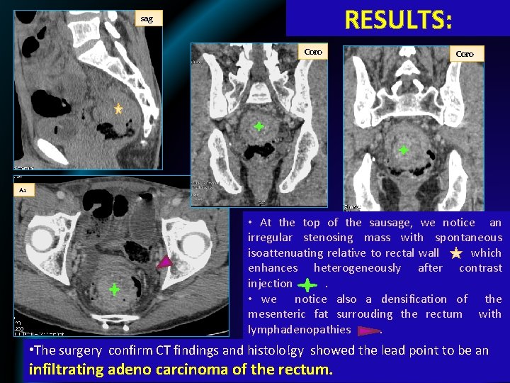 RESULTS: sag Coro Ax • At the top of the sausage, we notice an