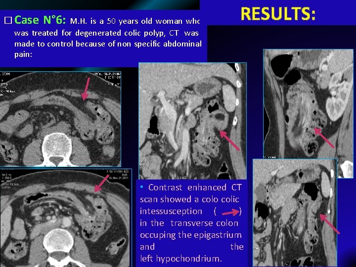 � Case N° 6: M. H. is a 50 years old woman who RESULTS: