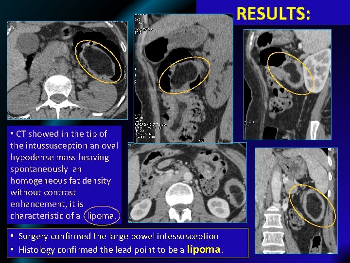 RESULTS: • CT showed in the tip of the intussusception an oval hypodense mass