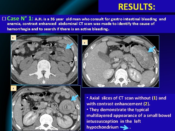 RESULTS: � Case N° 1: A. H. is a 36 year old man who