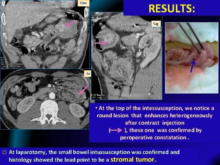 Coro RESULTS: Sag Ax • At the top of the intessusception, we notice a