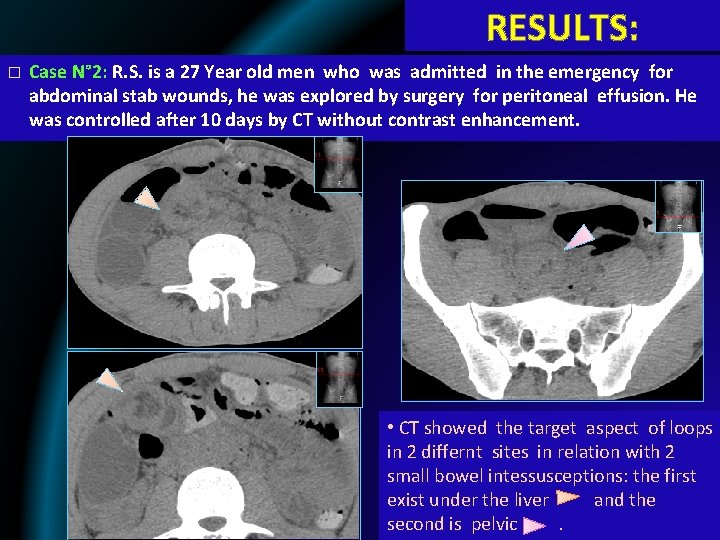 RESULTS: � Case N° 2: R. S. is a 27 Year old men who