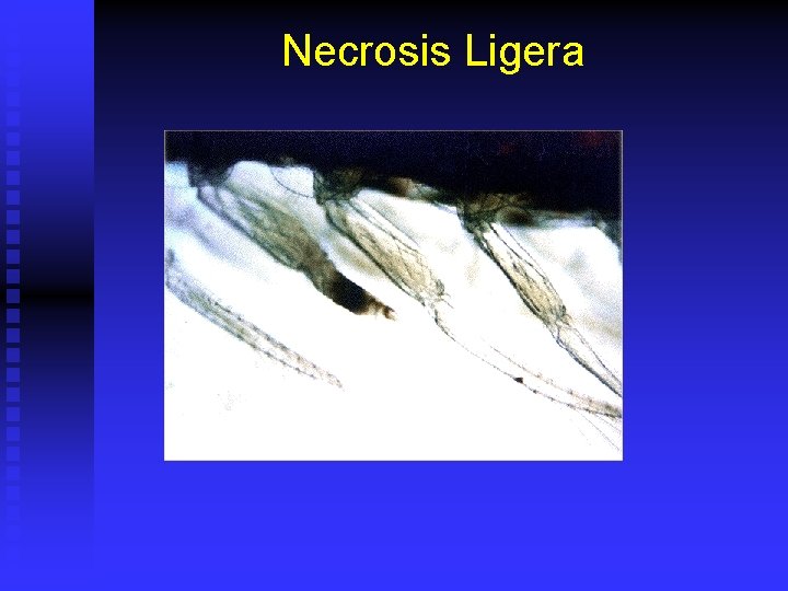 Necrosis Ligera 