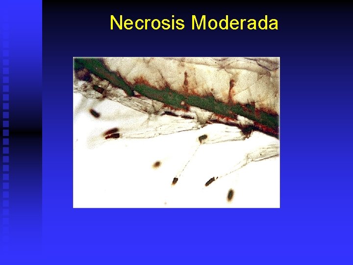 Necrosis Moderada 