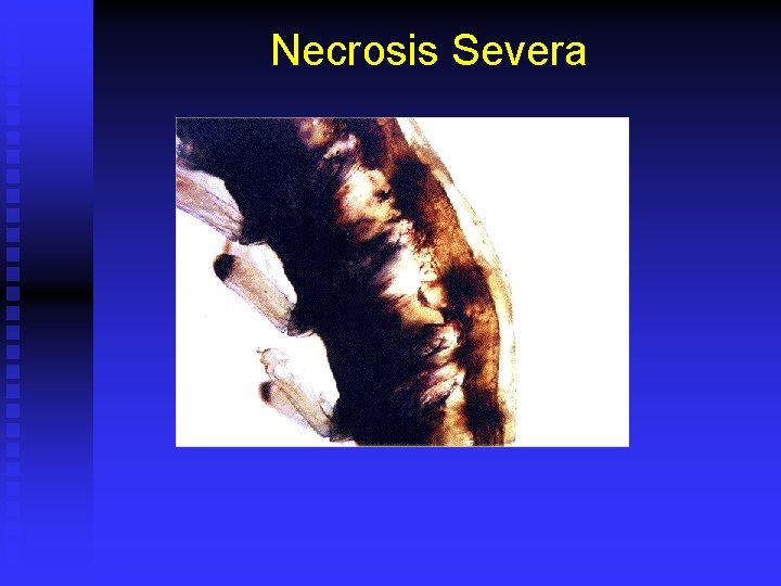 Necrosis Severa 