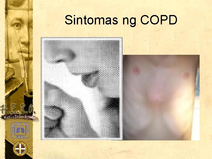 Sintomas ng COPD 