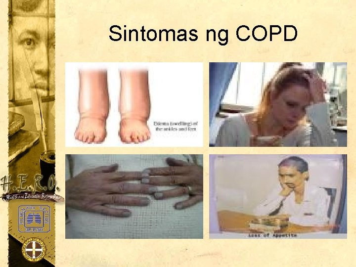Sintomas ng COPD 