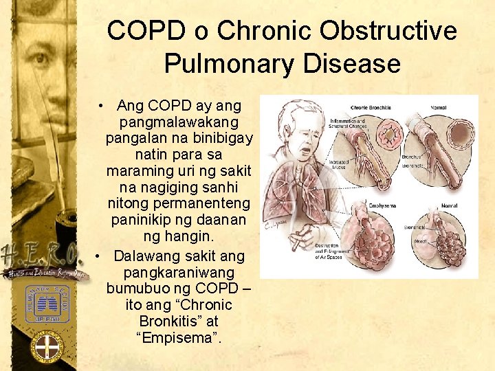 COPD o Chronic Obstructive Pulmonary Disease • Ang COPD ay ang pangmalawakang pangalan na