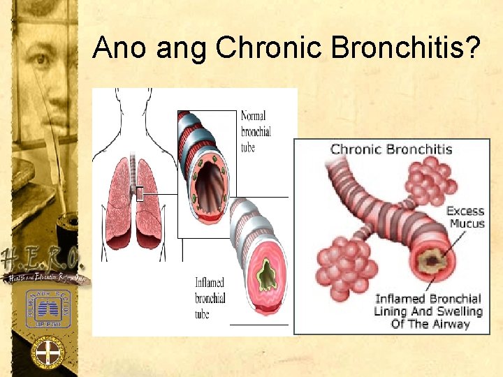 Ano ang Chronic Bronchitis? 