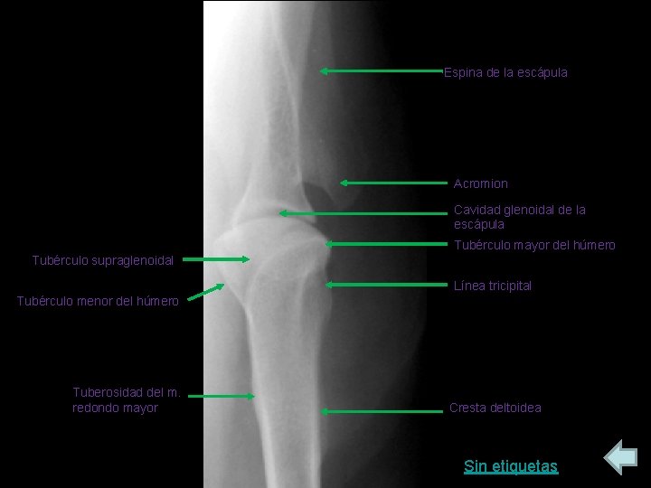 Espina de la escápula Acromion Cavidad glenoidal de la escápula Tubérculo mayor del húmero