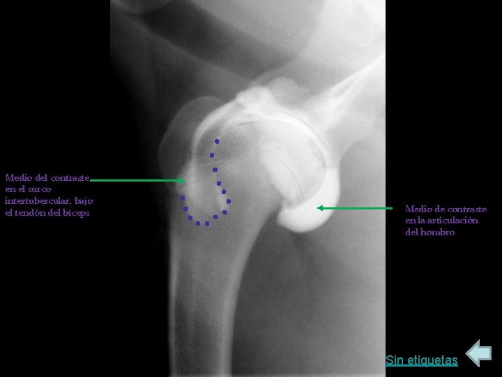 Medio del contraste en el surco intertubercular, bajo el tendón del bíceps Medio de
