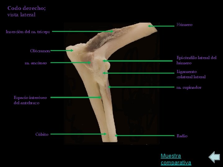Codo derecho; vista lateral Húmero Inserción del m. tríceps Olécranon m. ancóneo Epicóndilo lateral