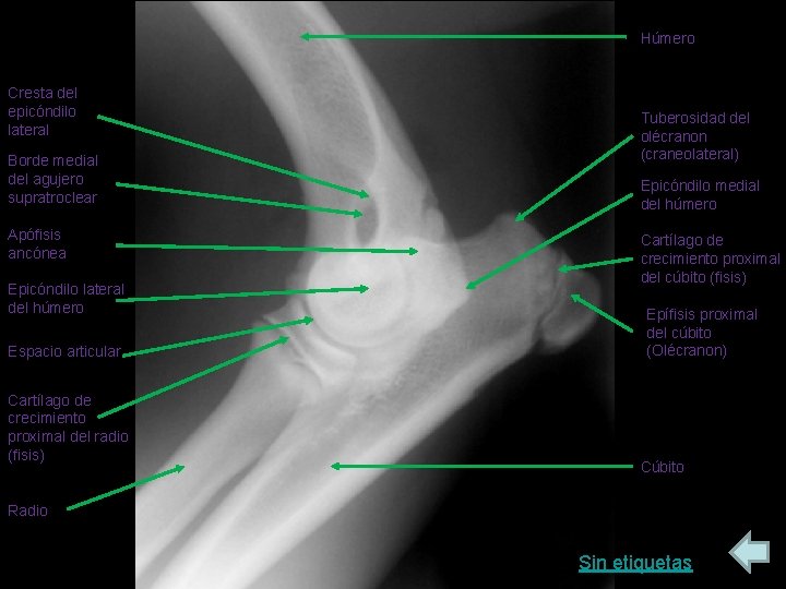 Húmero Cresta del epicóndilo lateral Borde medial del agujero supratroclear Apófisis ancónea Epicóndilo lateral