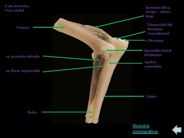 Codo derecho; Vista medial Húmero Inserción del m. tríceps – cabeza larga Tuberosidad del