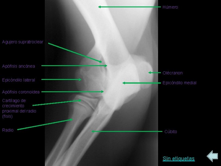 Húmero Agujero supratroclear Apófisis ancónea Olécranon Epicóndilo lateral Epicóndilo medial Apófisis coronoidea Cartílago de