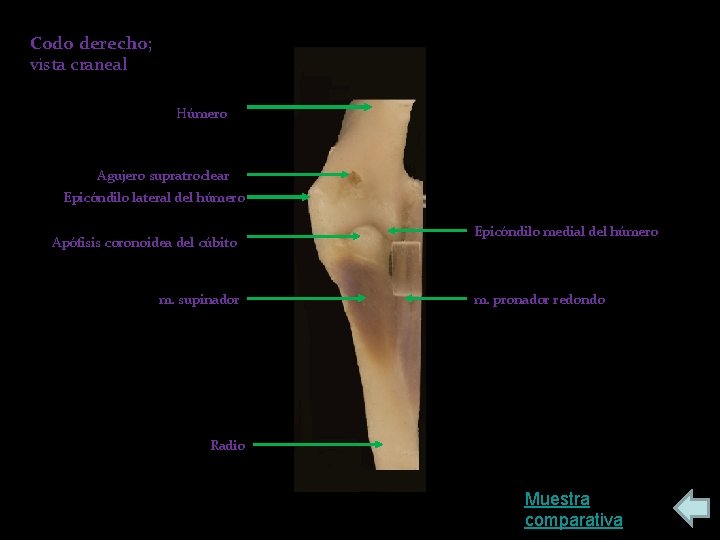 Codo derecho; vista craneal Húmero Agujero supratroclear Epicóndilo lateral del húmero Apófisis coronoidea del