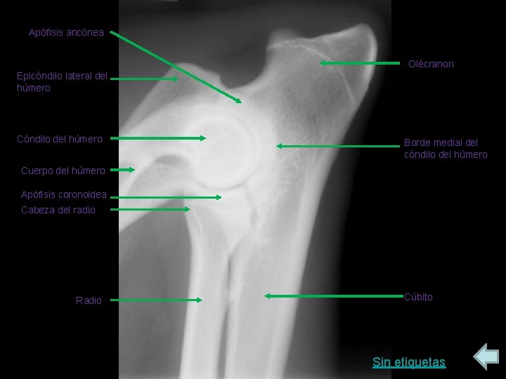 Apófisis ancónea Olécranon Epicóndilo lateral del húmero Cóndilo del húmero Borde medial del cóndilo