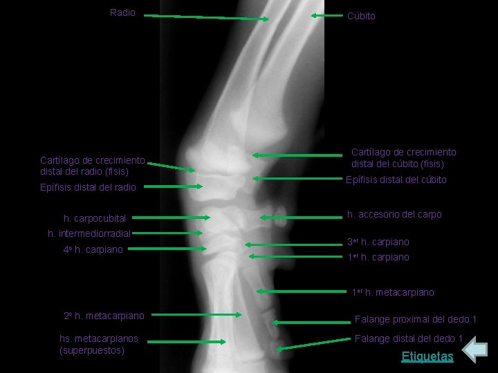 Radio Cartílago de crecimiento distal del radio (fisis) Epífisis distal del radio h. carpocubital