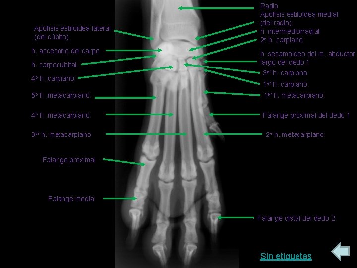 Apófisis estiloidea lateral (del cúbito) h. accesorio del carpo h. carpocubital 4 o h.