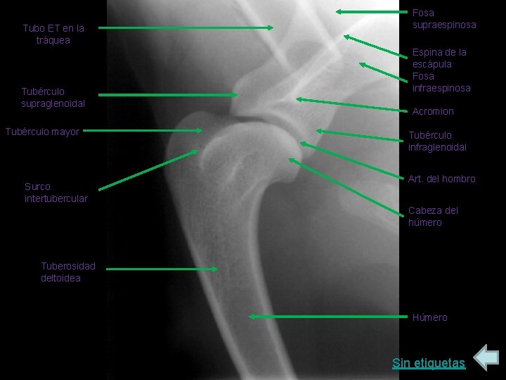 Tubo ET en la tráquea Tubérculo supraglenoidal Tubérculo mayor Surco intertubercular Fosa supraespinosa Espina