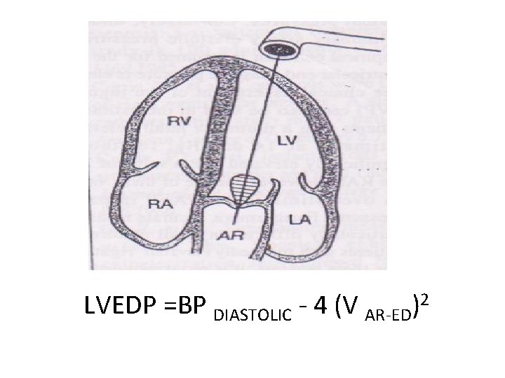 LVEDP =BP DIASTOLIC - 4 (V AR-ED)2 