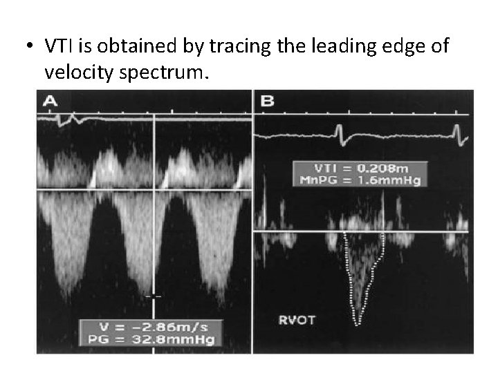  • VTI is obtained by tracing the leading edge of velocity spectrum. 