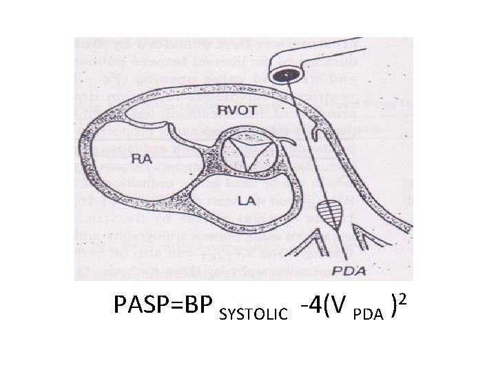 PASP=BP SYSTOLIC -4(V PDA )2 