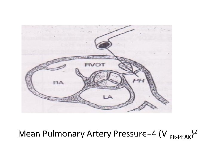 Mean Pulmonary Artery Pressure=4 (V PR-PEAK)2 