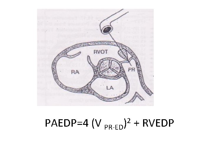PAEDP=4 (V PR-ED)2 + RVEDP 