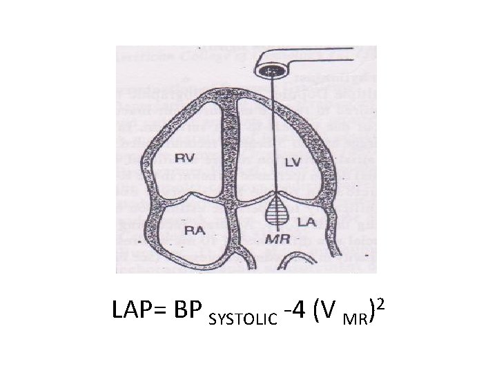 LAP= BP SYSTOLIC -4 (V MR)2 