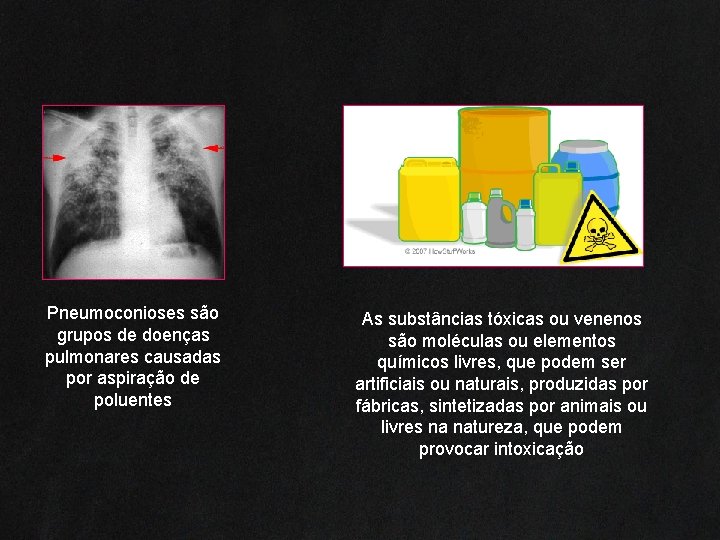 Pneumoconioses são grupos de doenças pulmonares causadas por aspiração de poluentes As substâncias tóxicas
