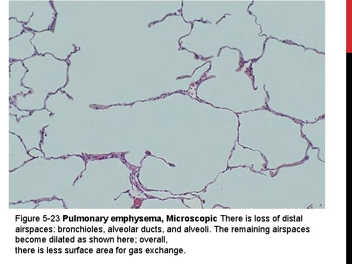 Figure 5 -23 Pulmonary emphysema, Microscopic There is loss of distal airspaces: bronchioles, alveolar