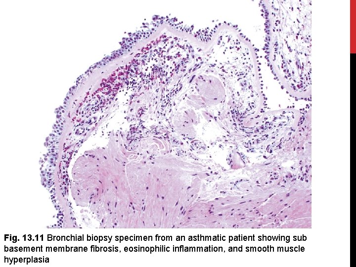 Fig. 13. 11 Bronchial biopsy specimen from an asthmatic patient showing sub basement membrane