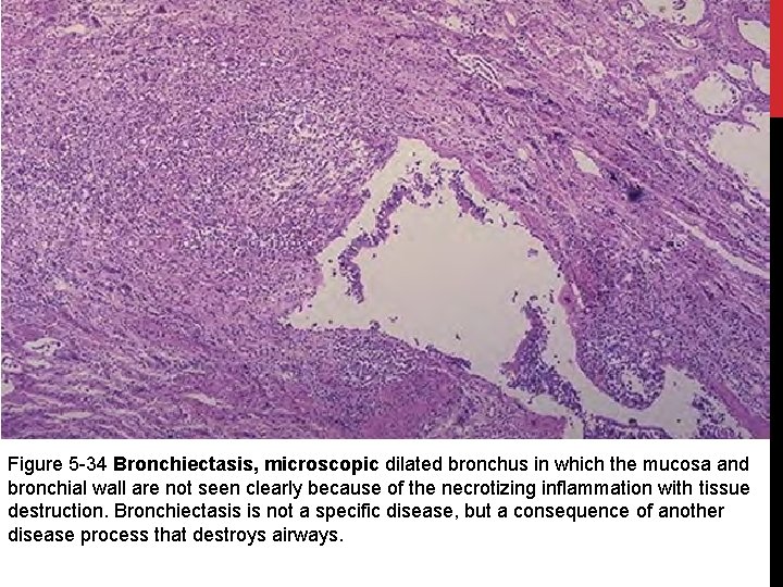 Figure 5 -34 Bronchiectasis, microscopic dilated bronchus in which the mucosa and bronchial wall