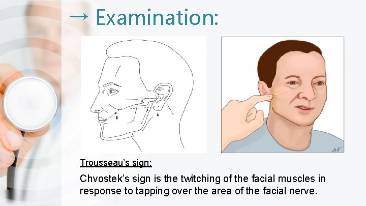 → Examination: Trousseau’s sign: Chvostek’s sign is the twitching of the facial muscles in