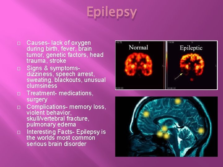 Epilepsy � � � Causes- lack of oxygen during birth, fever, brain tumor, genetic