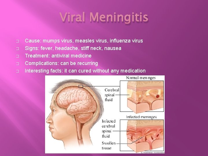 Viral Meningitis � � � Cause: mumps virus, measles virus, influenza virus Signs: fever,