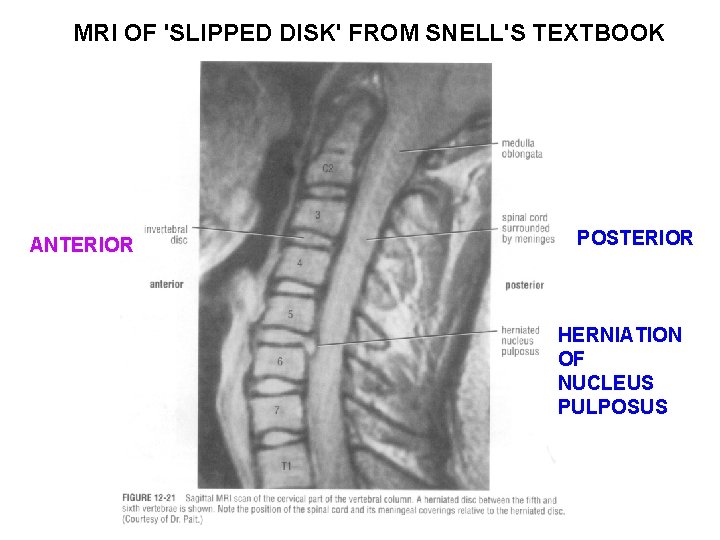 MRI OF 'SLIPPED DISK' FROM SNELL'S TEXTBOOK ANTERIOR POSTERIOR HERNIATION OF NUCLEUS PULPOSUS 