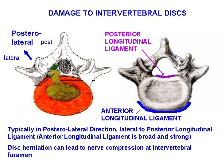 DAMAGE TO INTERVERTEBRAL DISCS Posterolateral post POSTERIOR LONGITUDINAL LIGAMENT lateral ANTERIOR LONGITUDINAL LIGAMENT Typically