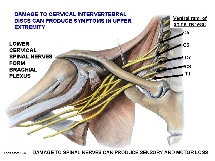 DAMAGE TO CERVICAL INTERVERTEBRAL DISCS CAN PRODUCE SYMPTOMS IN UPPER EXTREMITY LOWER CERVICAL SPINAL