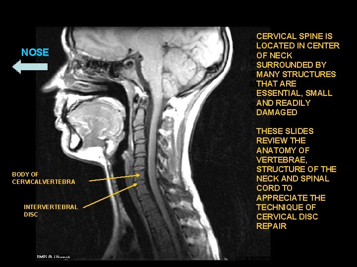 CERVICAL SPINE IS NOSE CERVICAL SPINE LOCATED IN CENTER ISOF LOCATED IN NECK CENTER