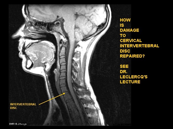 HOW IS DAMAGE TO CERVICAL INTERVERTEBRAL DISC REPAIRED? SEE DR. LECLERCQ'S LECTURE INTERVERTEBRAL DISC
