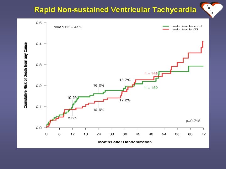 Rapid Non-sustained Ventricular Tachycardia 